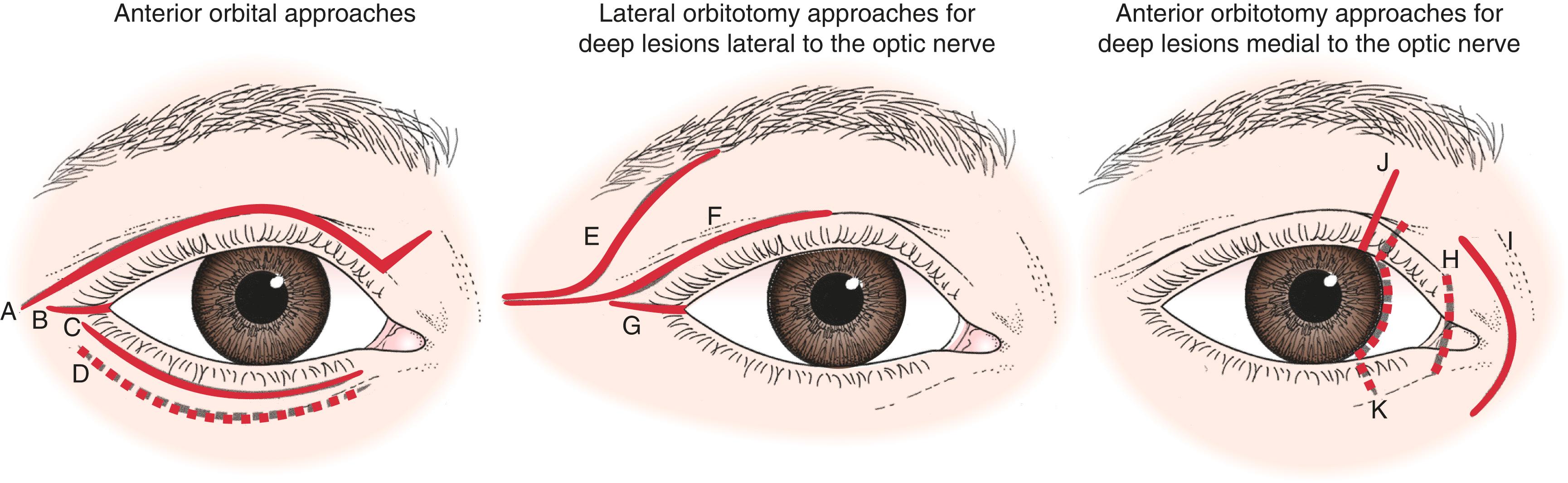 Figure 15.3, Surgical incisions for orbitotomy. Anterior orbital approaches: A , Upper lid skin crease incision. B , Lateral canthotomy incision. C , Lower lid transcutaneous incision. D , Lower lid transconjunctival incision. Lateral orbitotomy approaches for deep lesions lateral to the optic nerve: E , Stallard–Wright lateral orbitotomy incisions. F , Upper lid skin crease incision with lateral canthal extension. G , Modified lateral canthotomy incision. Anterior orbitotomy approaches for deep lesions medial to the optic nerve: H , Transcaruncular incision. I , Frontoethmoidal Lynch incision. J , Vertical lid split incision. K , Transconjunctival medial orbitotomy incision. Transcranial and transnasal approaches are not shown.