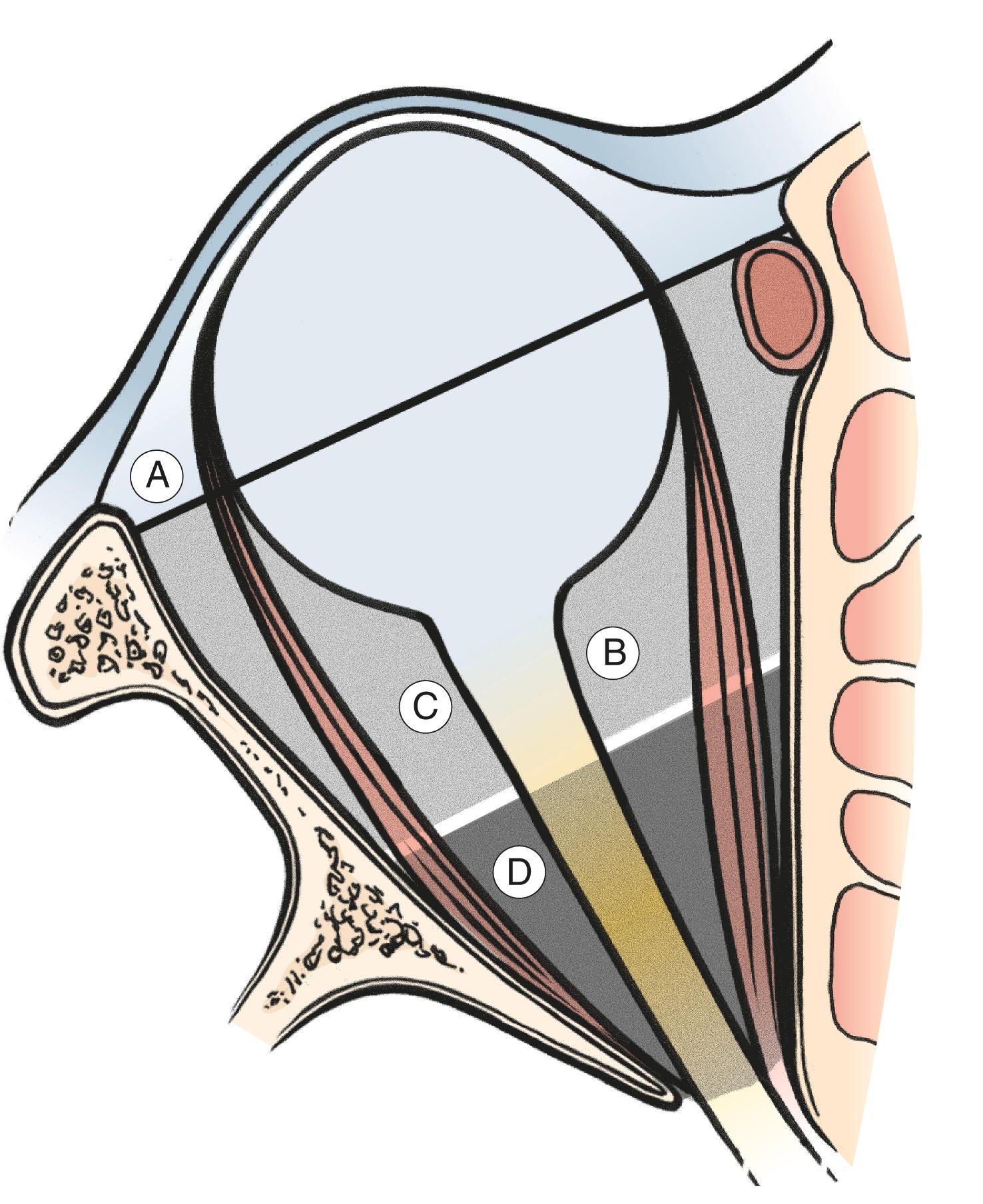 Figure 15.4, The choice of orbitotomy approach is based on the position of the mass. A , Anterior to the equator of the eye: anterior orbitotomy. B , Posterior to the globe and medial to the nerve: deep medial anterior orbitotomy. C , Posterior to the globe and lateral to the nerve: lateral orbitotomy. D , Involving the posterior one third of the orbit: transcranial orbitotomy.