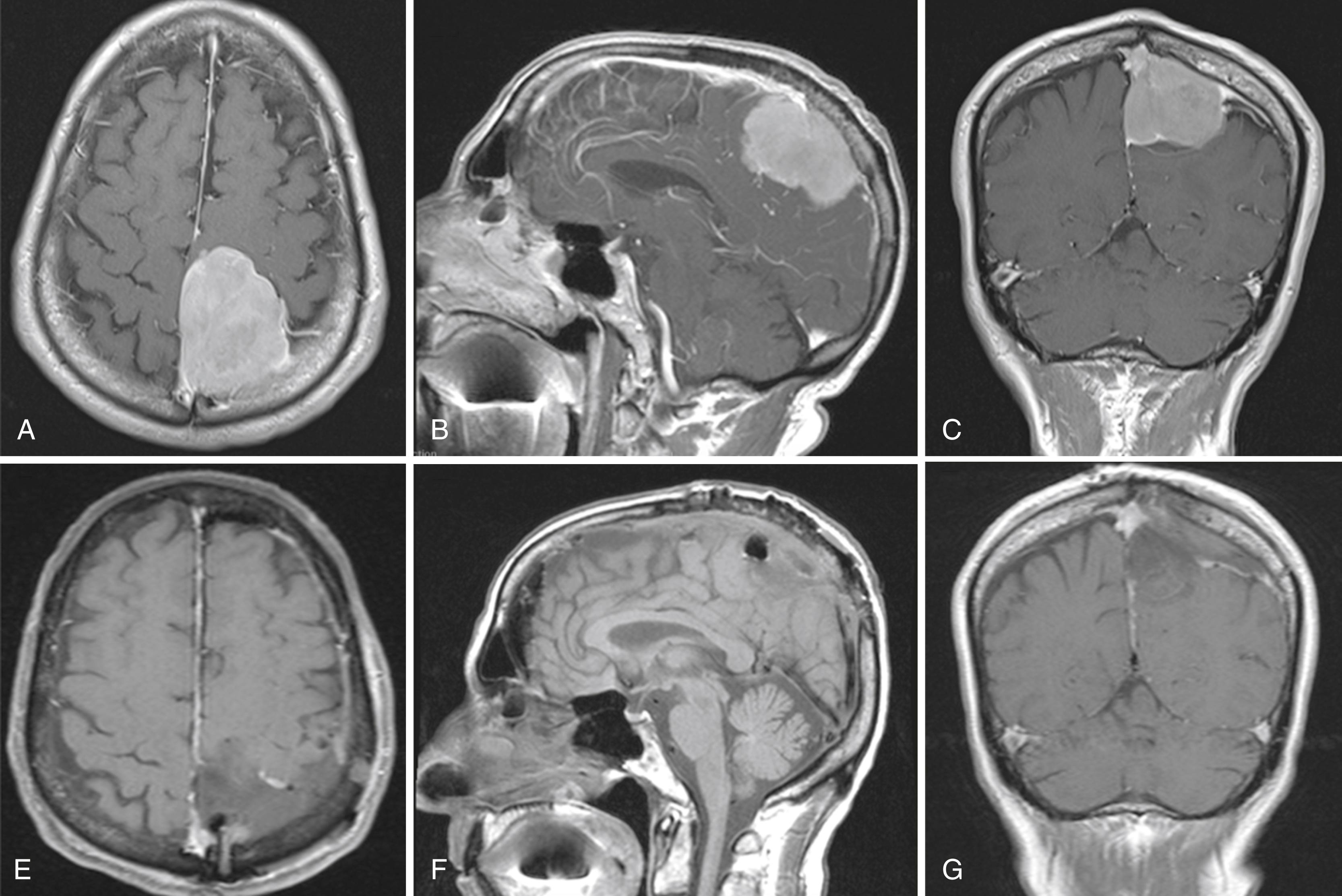 FIGURE 24.1, Seventy-five-year-old male patient presented with right lower extremity weakness and found on workup to have a left extra-axial peri-Rolandic mass. A to C, T1-weighted images (Axial, Sagittal, Coronal, respectively) show a 5.2 × 4.3 × 4.4 cm heterogeneously enhancing left parietal parafalcine mass suggested to be meningioma with focal invasion into the posterior third of the superior sagittal sinus. D to F, T1-weighted image showing gross total resection of the tumor with expected postoperative changes. Histopathology reported a WHO grade I Meningioma.