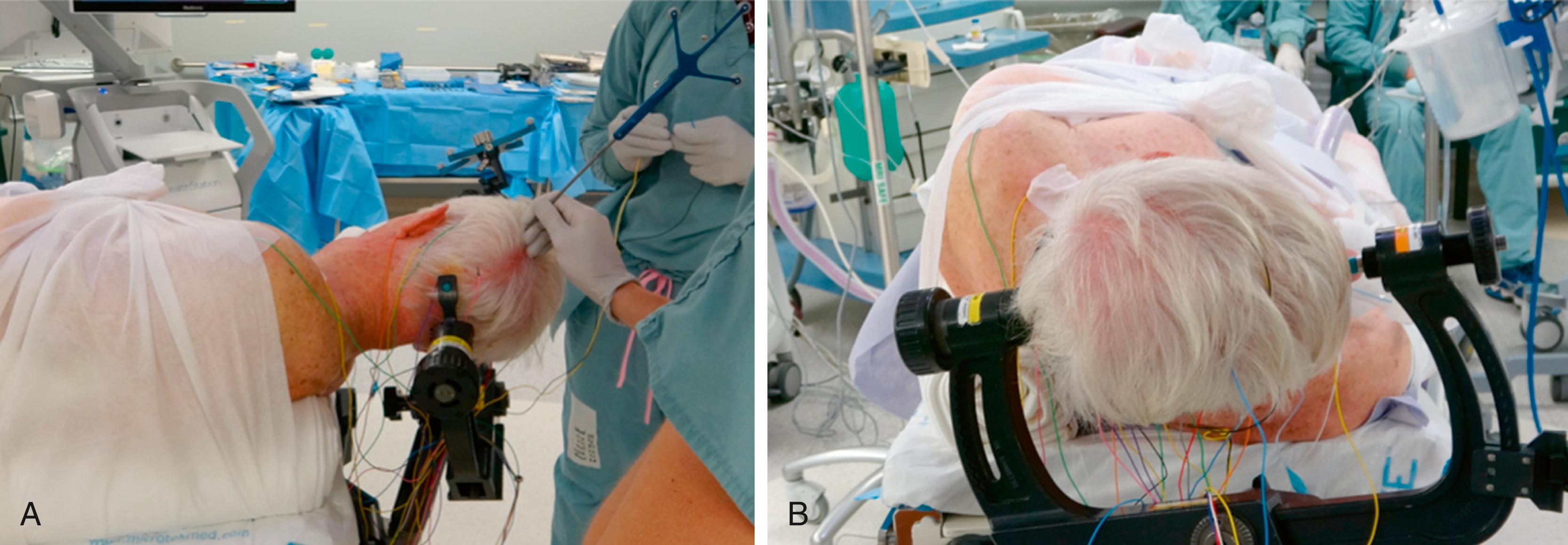 FIGURE 24.2, Patient positioning. A and B, Supine position, with large pad under the left side, right side down, The Head is fixed in a three-pin Mayfield head holder, turned towards the contralateral side and the neck is extended to facilitate the airflow.