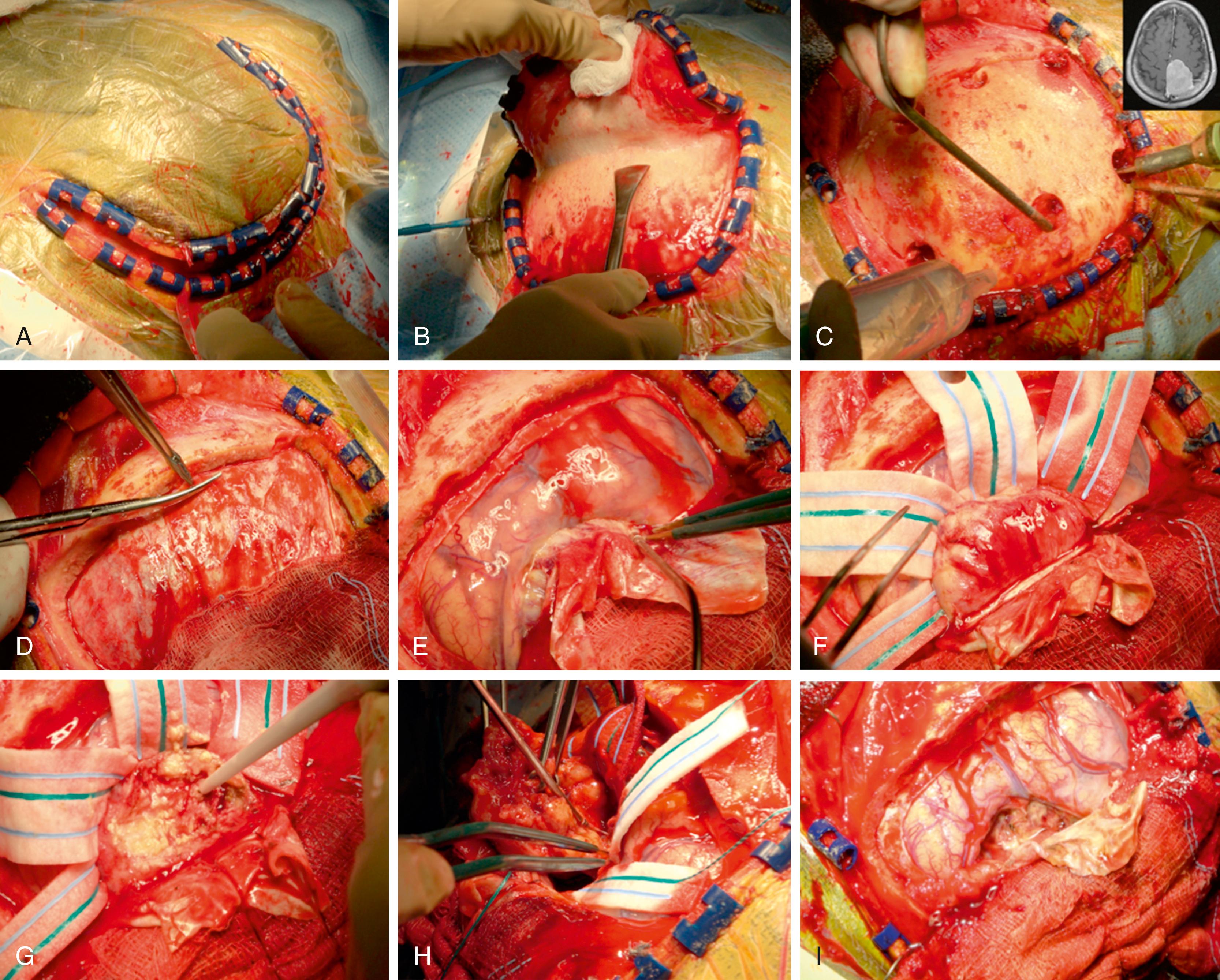 FIGURE 24.3, Surgical Procedure—Left-sided supratentorial craniotomy for tumor resection. (A, B, and C), For the craniotomy, three burr holes are performed against the superior sagittal sinus (SSS) and then three burr holes inferiorly. Neuronavigation planning allowed to identify the critical structures and to plan the craniotomy burr holes avoiding disruption of the SSS. (D) Dura is opened in a U-shaped fashion and (E), the tumor is easily identified. After identification, surgeons begun to dissect and (F), to create a plane, preserving all the veins and the vessels in the SSS. (G) Tumor is debulked with the use of ultrasonic aspiration and (H) the capsule is then carefully dissected from the dura. Careful coagulation of all the small vessels is done. (I) Adequate hemostasis is established before closure.