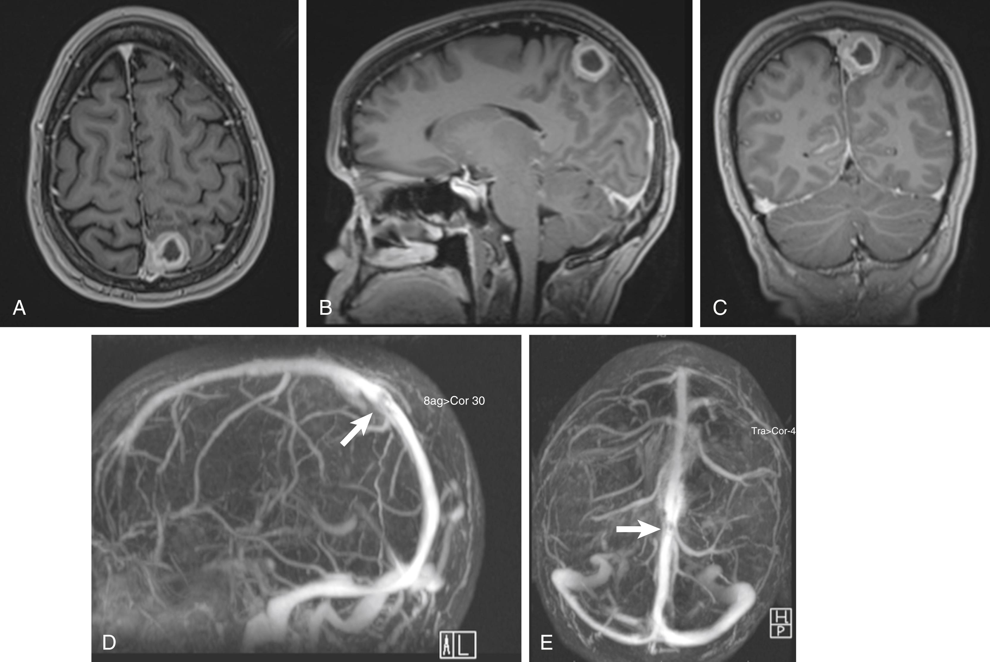 FIGURE 24.4, FForty-two-year-old female patient presented with neck pain and occipital headaches and found on workup to have a left-sided mass. A to C, T1-weighted images show a 2.9 × 2.2 × 2.2 cm left parasagittal extra-axial contrast enhancing mass demonstrating invasion into the posterior superior sagittal sinus (SSS). Associated mild mass effect upon the left parietal lobe with suggestion of pial invasion. D and E, Moderate to severe focal stenosis of the posterior third of the SSS (arrows) secondary to the invading mass. The remainder of the dural venous sinuses are patent. Histopathology revealed an atypical WHO grade II meningioma with increased mitotic activity.