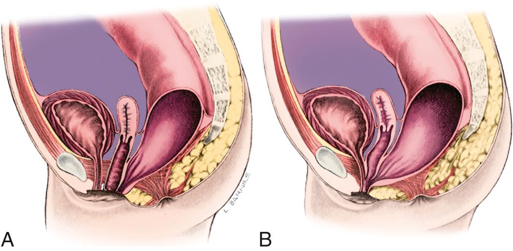 Fig. 371.3, Imperforate anus in females.