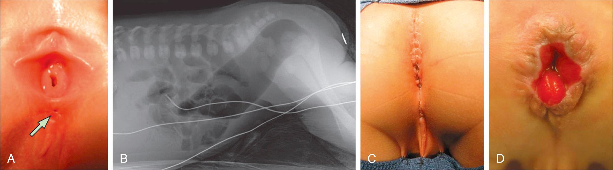 Fig. 371.4, Preoperative and postoperative images of anorectal malformations.