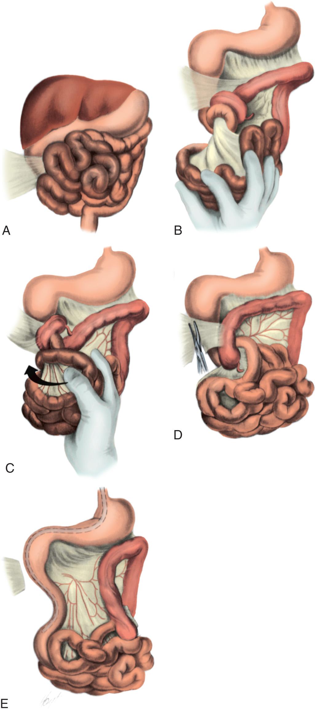 malrotation of intestine