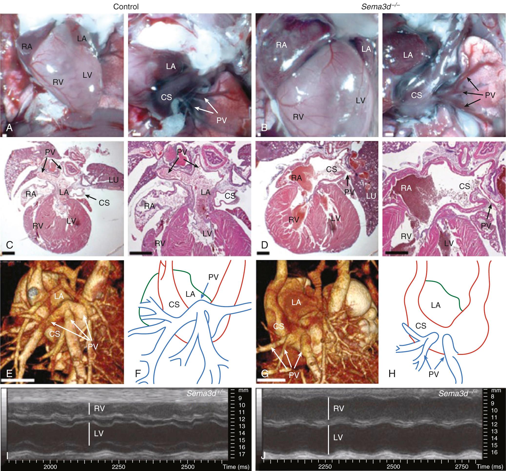 FIGURE 115-2, Mice heart comparison between Semaphorin3d−/− type and control. Anterior views of (A) adult control and (B) Sema3d−/− hearts. Severe cardiomegaly is showed the mutants (B) because of right atrial (RA) and right ventricular (RV) dilation. In mutant mouse pulmonary veins (PV) enter the coronary sinus (CS; in B, left image). In control mice (A), pulmonary veins (PV) enter the left atrium (LA) as normal. C and D, Photomicrographs of hematoxylin and eosin–stained sections showing a normal connection of the pulmonary veins to the left atrium in Sema3d+/− mice (C) and anomalous pulmonary venous connections to the coronary sinus in Sema3d−/− mice (D). E–H, Volume-rendered micro–computed tomography images (dorsal view) showing the pulmonary veins entering the posterior left atrium in a newborn wild type mouse (E) and entering the coronary sinus in a newborn mutant mouse (G). F and H, The diagrams of the microCT images in E and G, respectively. I and J, M-mode echocardiograms through the ventricles of a Sema3d+/− (I) and a Sema3d−/− (J) heart showing the relative dilation of the right ventricle in an adult Sema3d−/− mouse and paradoxical septal wall motion indicative of right-sided volume overload. Scale bars (in panels A-E and G) = 1 mm. LU, Lung; LV, left ventricle.