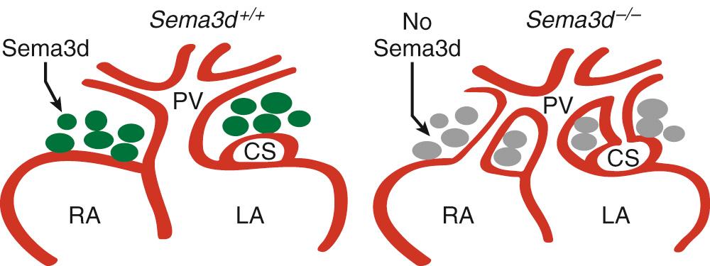 FIGURE 115-3, Model showing the role of Sema3d in pulmonary vein patterning. Normally (left) Sema3d is expressed between the heart and the developing pulmonary vasculature where it repels endothelial cells to prevent the formation of anomalous connections. Deficiency of Sema3d (right) allows endothelial cells to enter this region and form anomalous vascular connections. CS, Coronary sinus; LA, left atrium; PV, pulmonary veins; RA; right atrium.