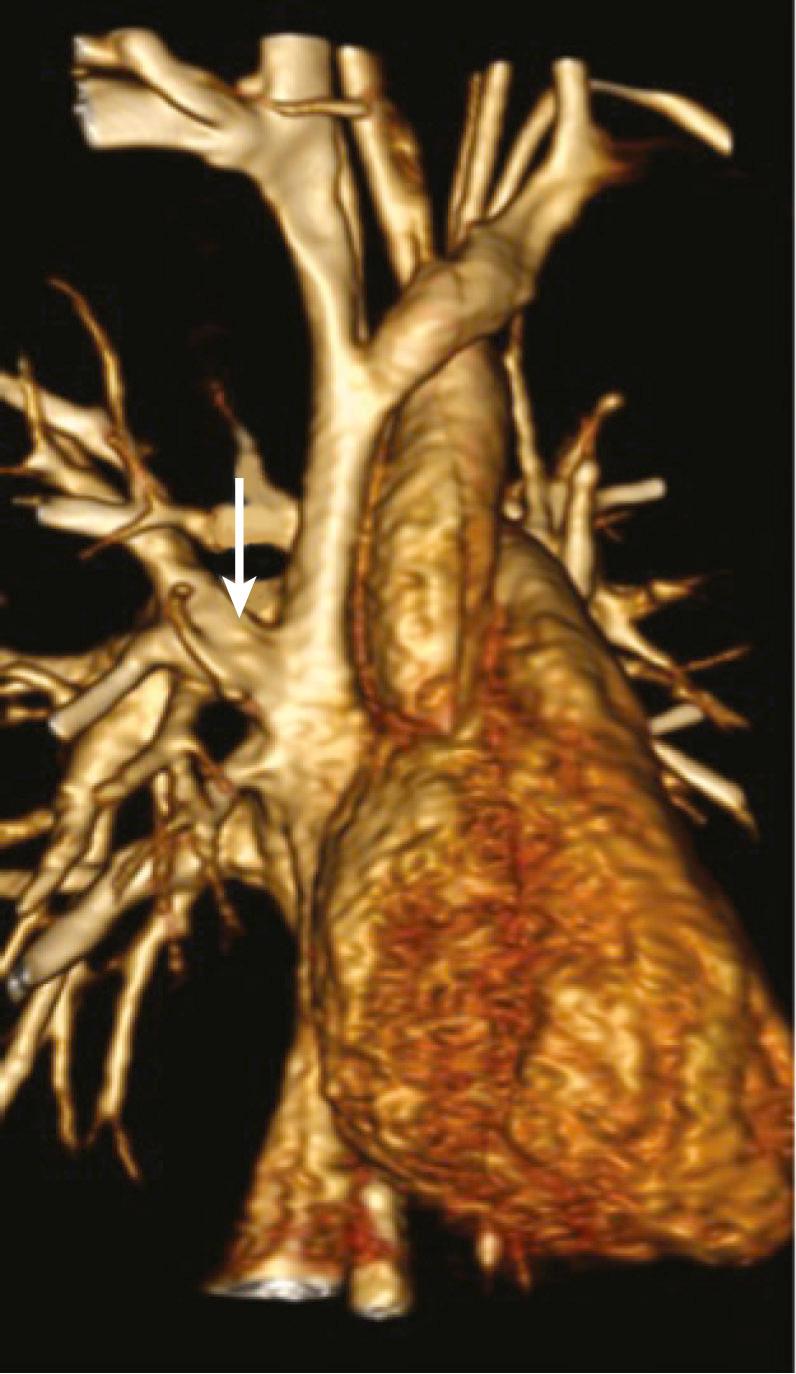 FIGURE 115-4, A contrast-enhanced magnetic resonance three-dimensional angiogram seen from right anterior projection shows an anomalous connection of the right upper and middle pulmonary vein draining into the superior vena cava (arrow). The right lower pulmonary vein normally drains into the left atrium.