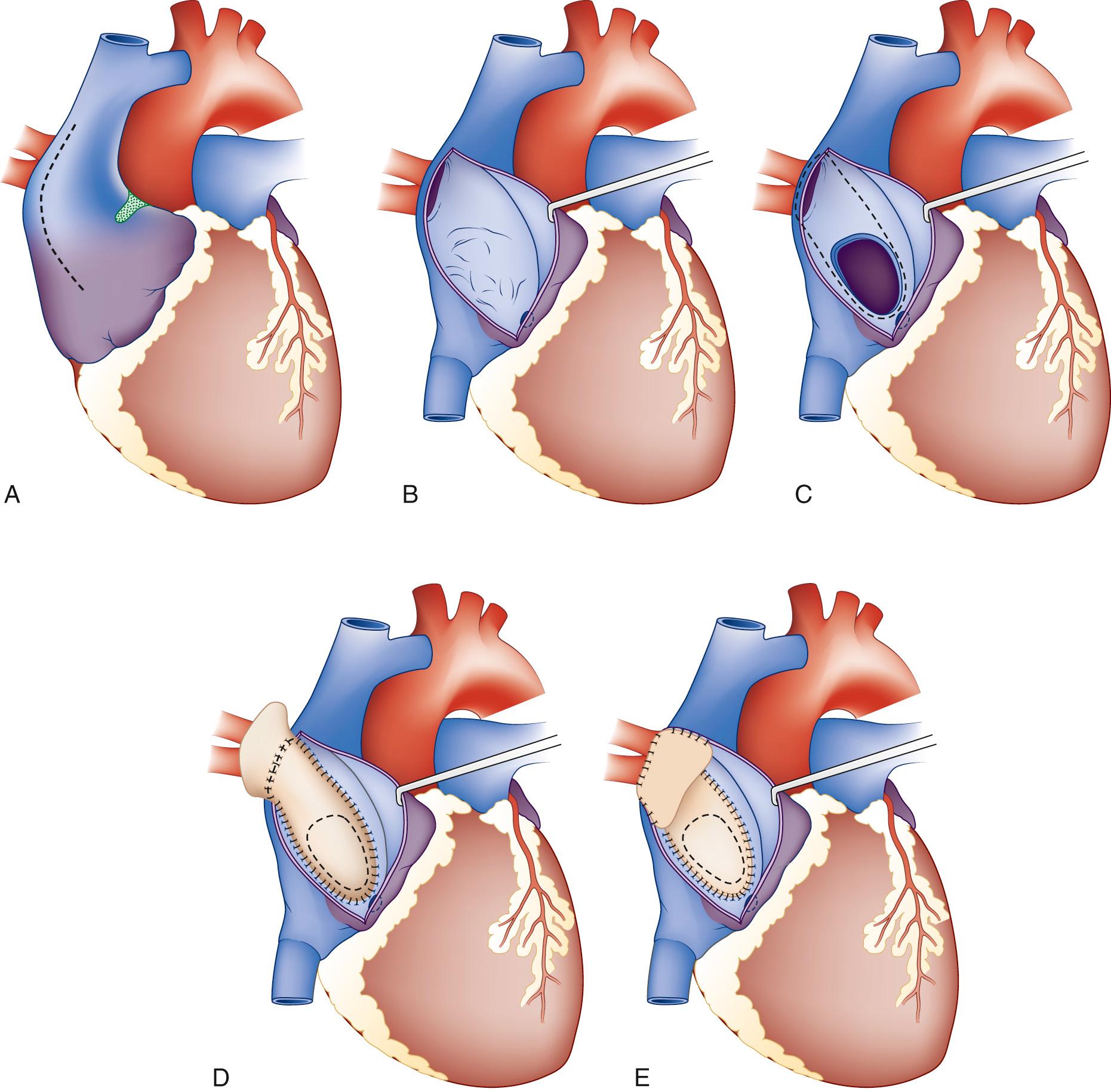 FIGURE 115-5, A, After initiation of cardiopulmonary bypass and cardioplegic arrest, a lateral right atrial incision is made (dashed line) . The stippled area represents the approximate location of the sinoatrial node. B, The orifice of the anomalous pulmonary veins and the intact atrial septum are exposed. A secundum atrial septal defect is created by excising the septum primum in the region of the limbus, with care taken to avoid potential injury to the conduction system by keeping clear of the triangle of Koch. C, The limbus can be resected cephalad to increase the diameter of the atrial septal orifice. D, A glutaraldehyde-treated autologous pericardial patch is sutured in place along the rim of the newly created defect, thereby creating a tunnel from the pulmonary vein orifice to the left atrium. E, The patch is deliberately longer than necessary to reach the pulmonary vein orifice, and the redundant portion is left unattached as the suture line is extended across the edge of the divided pulmonary vein–atrial edge. The redundant portion of the patch is then folded anteriorly to augment the diameter of the superior cavoatrial junction, thereby preventing obstruction of the superior vena cava.