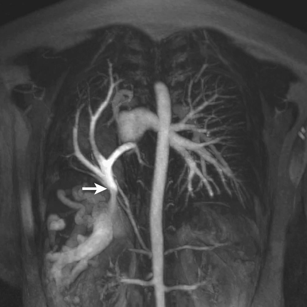 FIGURE 115-6, Contrast-enhanced magnetic resonance angiogram shows the scimitar vein draining most of the right pulmonary venous blood flow into the inferior vena cava (arrow) . The scimitar vein has severe stenosis at its junction with the inferior vena cava.