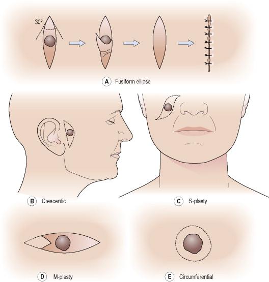 Figure 46.1, Excision shapes. A) Fusiform ellipse. Note that the angle formed by the ends approximates a 30° angle. This results in optimal apposition of the wound edges and minimizes the possibility of redundancies at the ends. B) Crescentic. C) S-plasty. D) M-plasty. E) Circumferential.