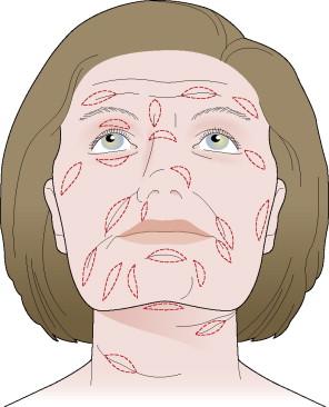 Figure 46.2, Excision orientation incorporating relaxed skin tension lines (lines of Langer).