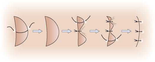 Figure 46.3, Closing by following the rule of halves.