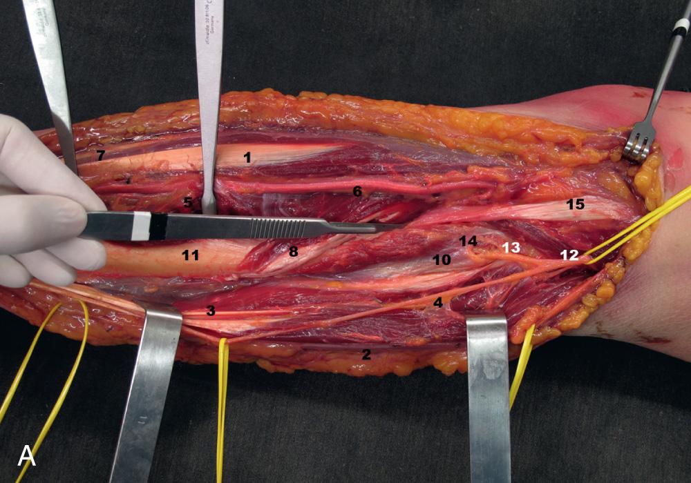 FIG 12.5, (A) The plane between the pronator teres and the supinator has been developed; note division of the radial nerve into the posterior interosseous nerve and the sensory branch. (B–D) Subperiosteal elevation of the supinator and detachment of the pronator teres allow exposure of the whole humeral shaft. 1, Flexor carpi radialis; 2, brachioradialis; 3, extensor carpi radialis longus and extensor carpi radialis brevis; 4, r. superficialis n. radialis; 5, flexor pollicis longus; 6, a. radialis; 7, palmaris longus; 8, pronator teres; 9, pronator quadratus; 10, supinator; 11, radius; 12, n. radialis; 13 , r. profundus n. radialis; 14, arcade of Frohse; 15, biceps brachii (tendon); 16, capitulum humeri; 17, caput radii; 18, tuberositas radii.