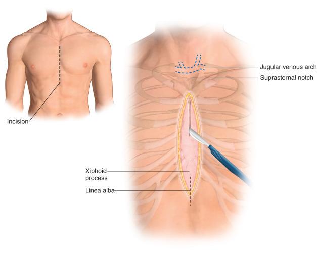 Figure 1.1, Standard median sternotomy. Identification and division at the middle of the sternum is the A and O. The skin incision could be reduced to ca. 10 cm and still divide the sternum completely.