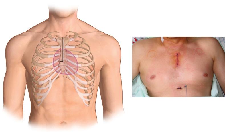 Figure 1.2, A partial sternotomy gives good exposure of the aortic root and could be selected to reduce the incidence of sternum instability and wound infection.