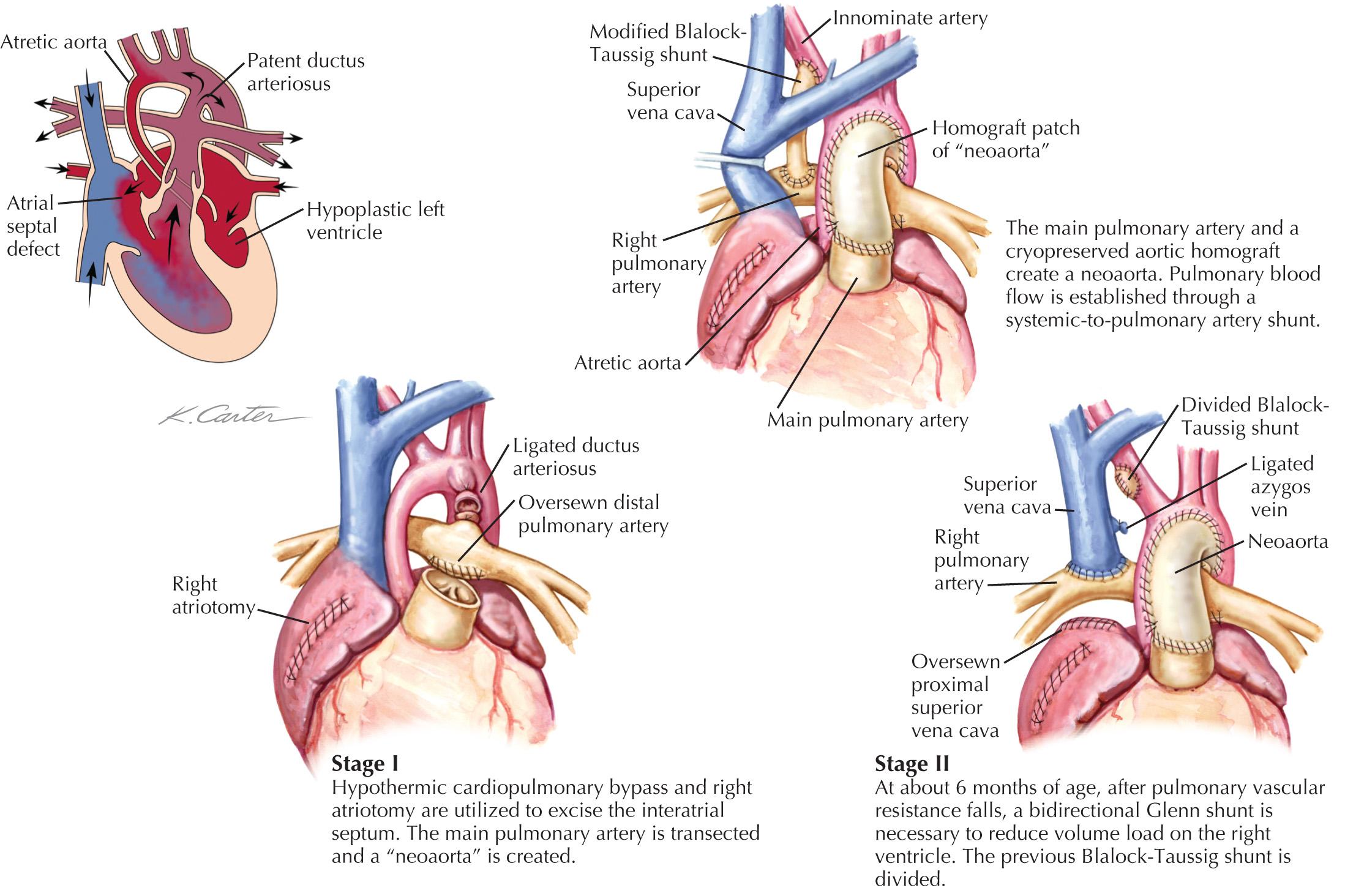 FIG 53.1, Norwood Correction of Hypoplastic Left-Sided Heart Syndrome.