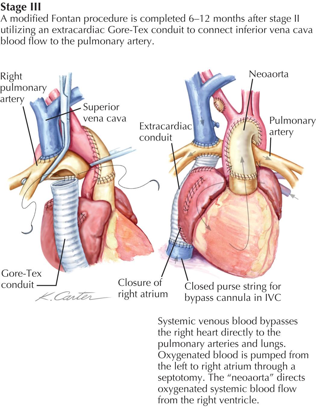 FIG 53.2, Norwood Correction of Hypoplastic Left-Sided Heart Syndrome: Fontan Circulation.