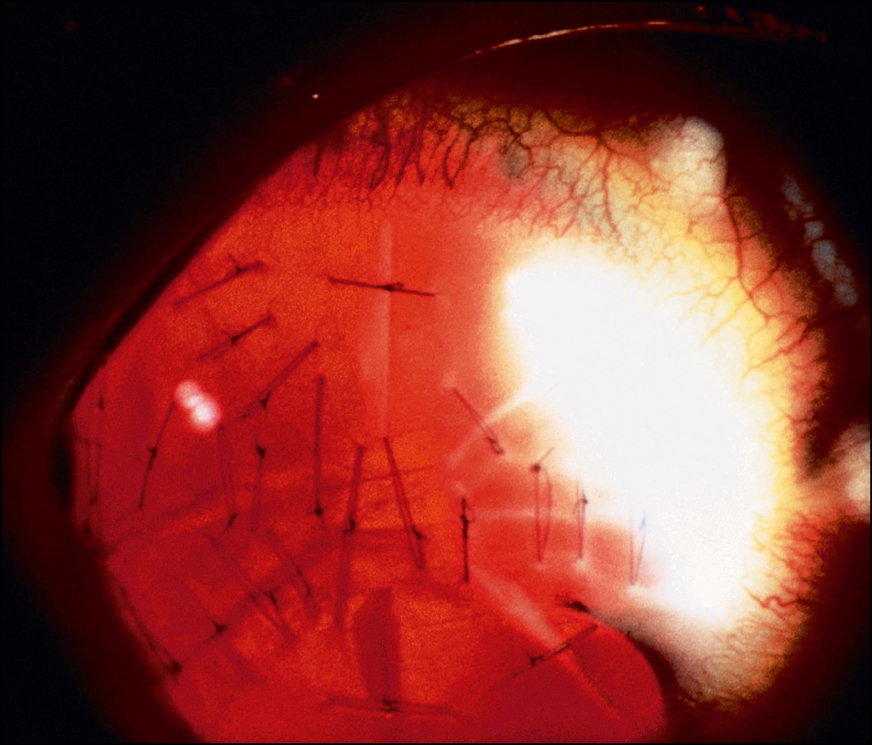 Fig. 149.1, Indirect illumination of surgically repaired rupture of radial keratotomy incisions after blunt trauma.