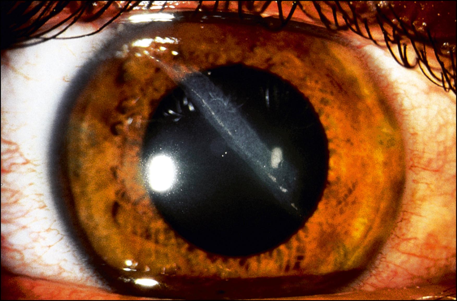 Fig. 149.2, Slit lamp photograph of an oblique shelved partial-thickness corneal laceration.