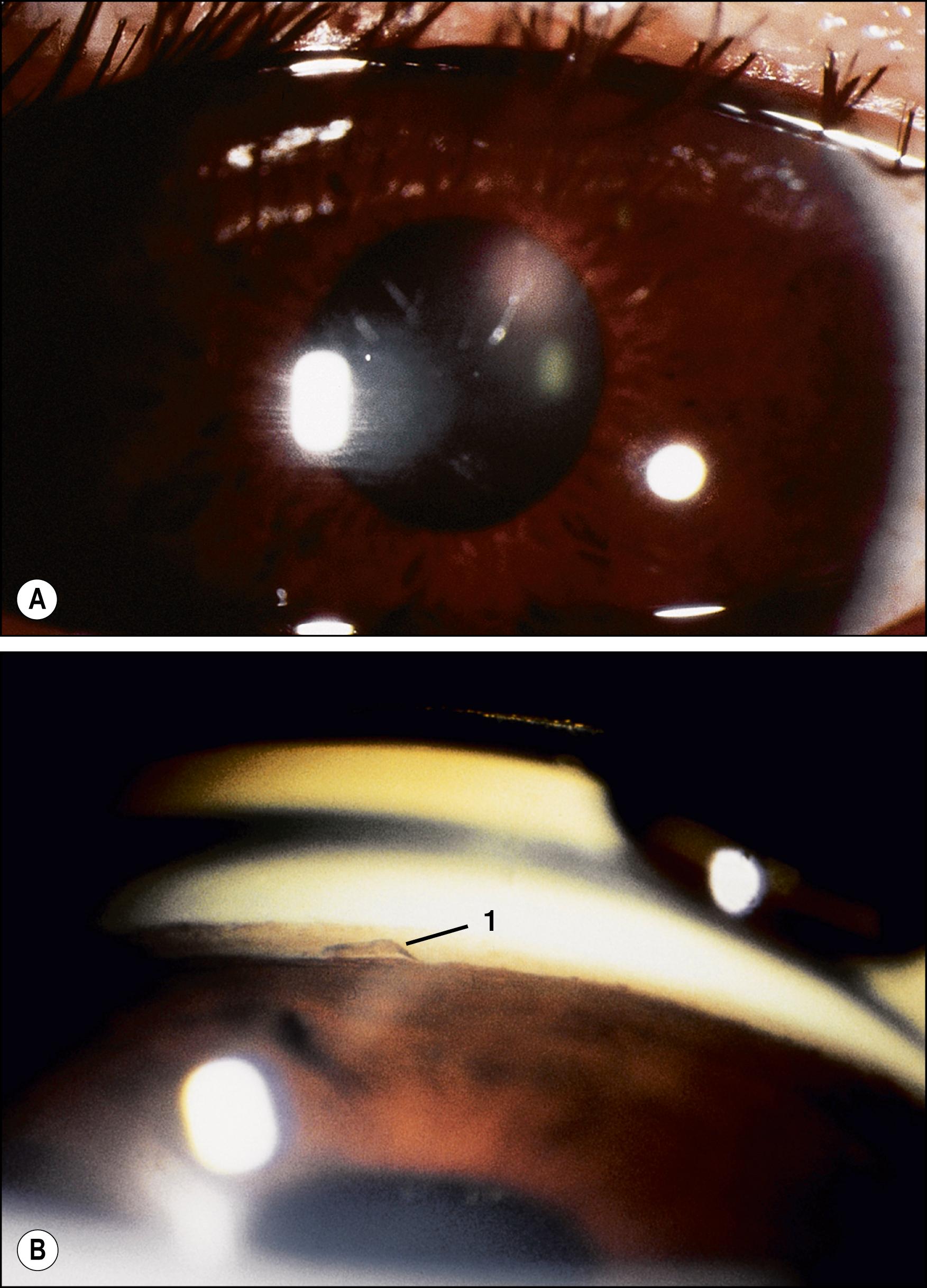 Fig. 149.4, Metallic foreign body.