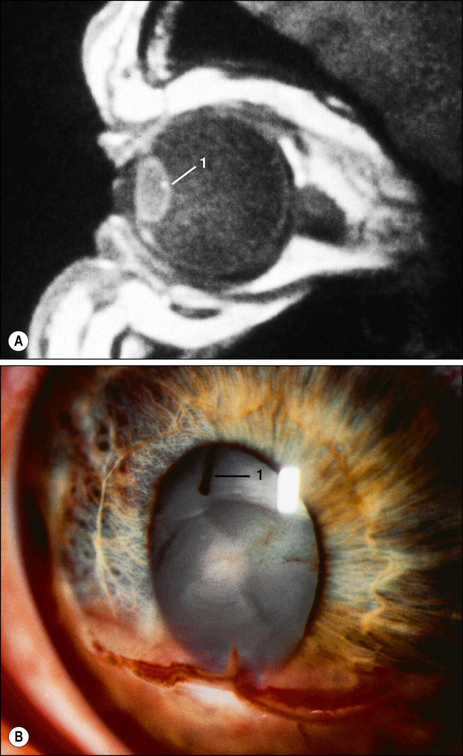 Fig. 149.6, Intralenticular foreign body.