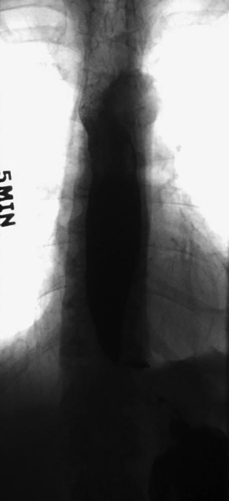 FIGURE 11.1, Barium swallow demonstrating classic bird’s-beak appearance with a dilated esophagus and tapering at the gastroesophageal junction.