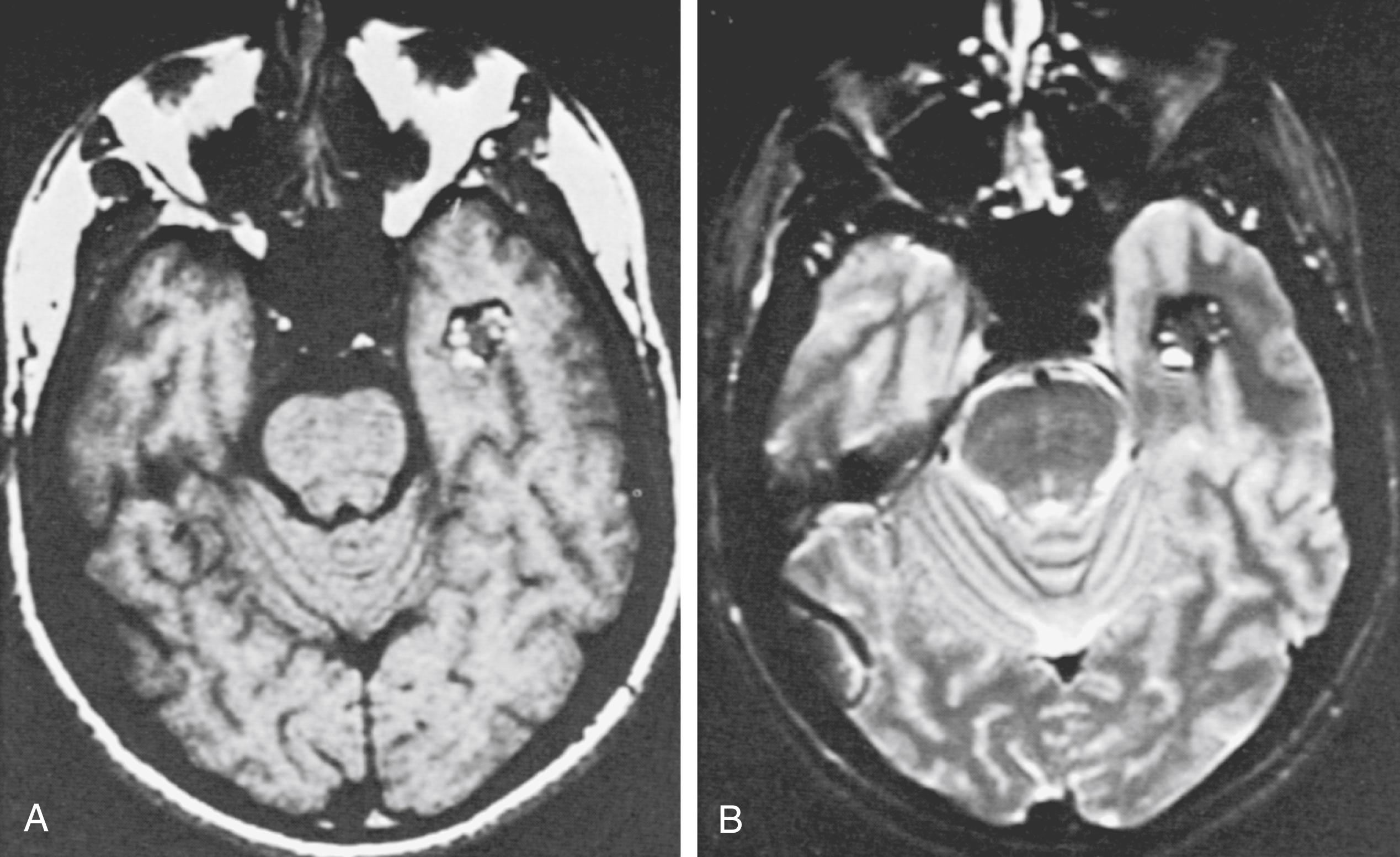 FIGURE 55.1, Temporal cavernous malformation in a 34-year-old man presenting with a seizure. Removal of the lesion was followed by a normal recovery. Axial T1-weighted (A) and T2-weighted (B) MRI showed a well-circumscribed lesion in the left temporal lobe with a mottled core of mixed signal intensity and a surrounding rim of decreased signal intensity.