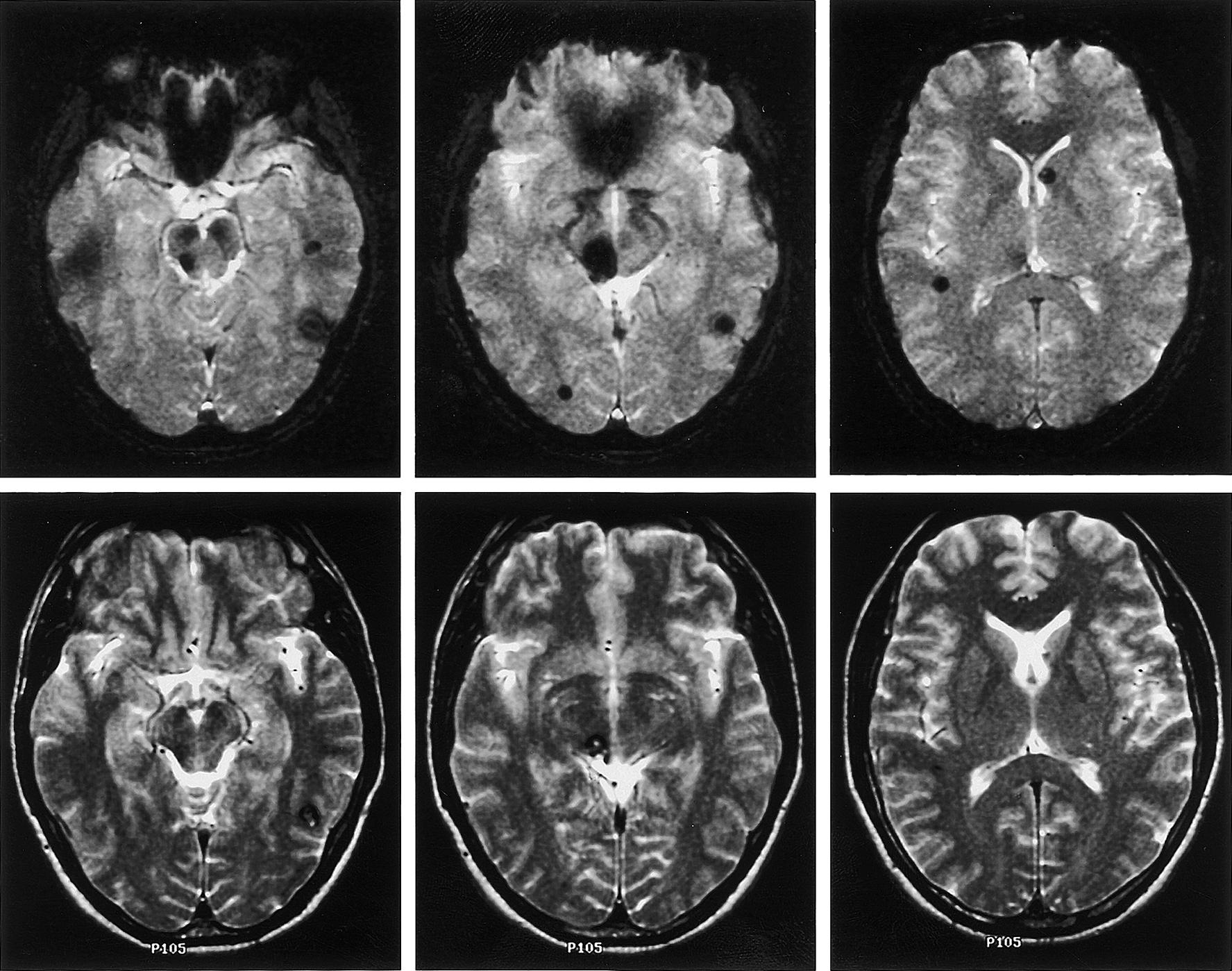 FIGURE 55.2, MRI in a middle-aged man with a family history of cavernous malformations (CMs) who presented with seizures. T2-weighted images (bottom panel) revealed well-circumscribed lesions with a reticulated or mottled core of mixed signal intensity, typical for CMs. Susceptibility MRI (top panel) demonstrates further lesions showing the multiplicity of CMs.