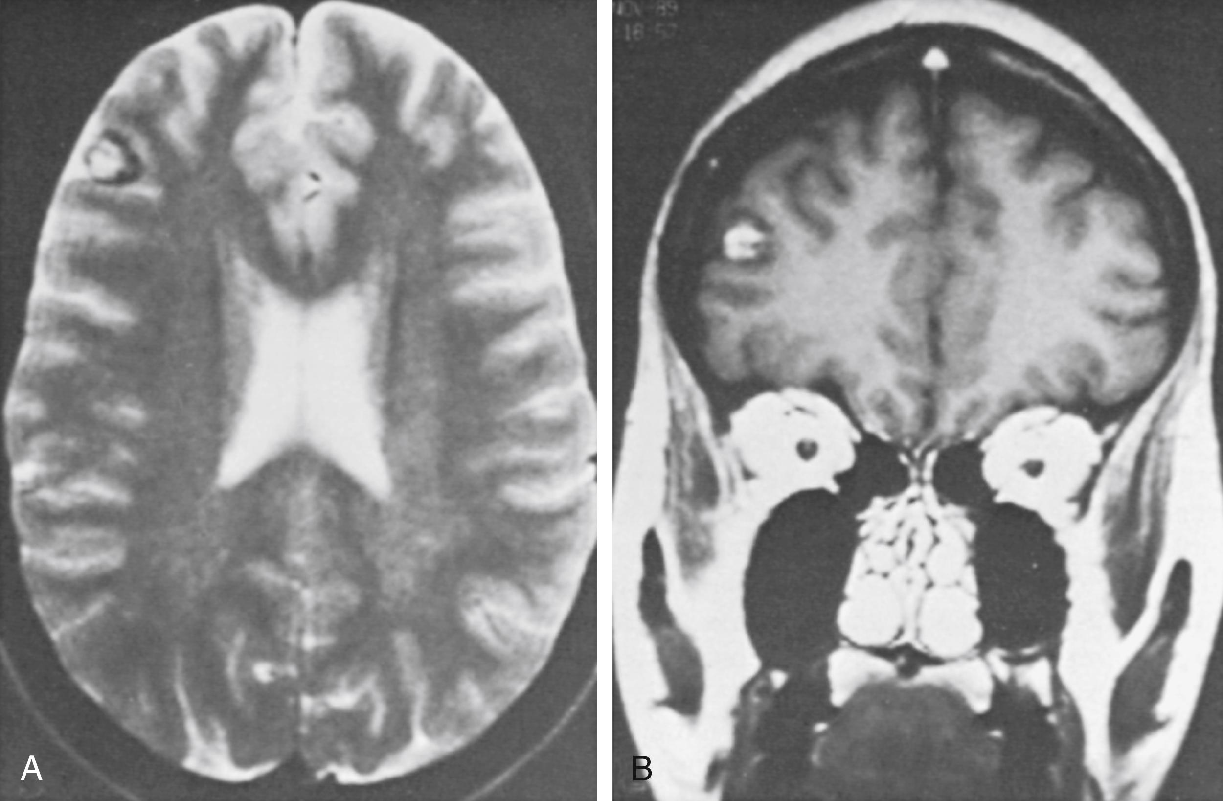 FIGURE 55.3, Frontal cavernous malformation in a 34-year-old woman presenting with seizures. The seizures were controlled with medication, but she wanted to become pregnant and requested surgical excision. Removal of the lesion was followed by normal recovery. Axial T2-weighted (A) and coronal T1-weighted (B) MRI showed a superficial right frontal lesion with no parenchymal hemorrhage.