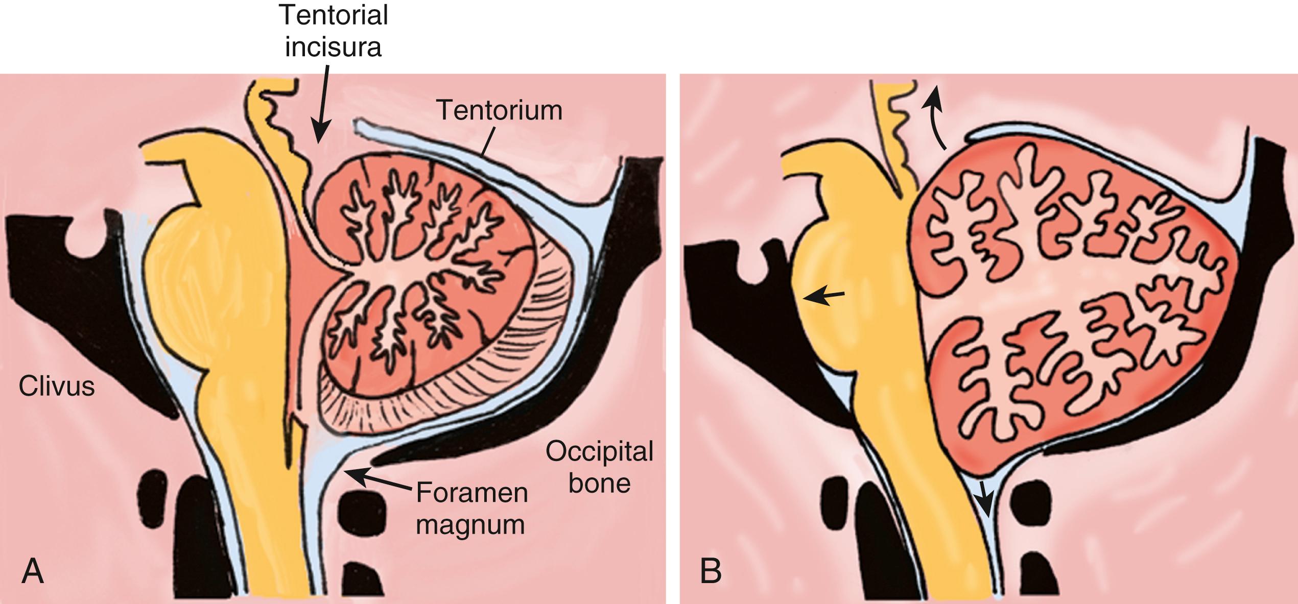 FIGURE 44.1, Posterior fossa. (A) Anatomy (midsagittal view). Note the space constrained by three surfaces: (1) the tentorium superiorly, (2) the skull base formed by the petrous bone and clivus ventrally, and (3) the suboccipital skull convexity surface dorsally and inferiorly. Also note the communications with the supratentorial space via the tentorial incisura and with the spinal canal via the foramen magnum. (B) Consequences of mass: cerebellar hemorrhage, or infarction with swelling, may cause effacement of the fourth ventricle, compression of the brain stem against the clivus, obstruction of cerebrospinal fluid flow through the aqueduct, and herniation upward through the tentorial incisura and/or downward through the foramen magnum.