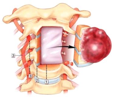 Figure 25.1, Illustration of parasagittal osteotomies for en bloc resection of multilevel cervical chordomas. Osteotomy locations are shown for tumors involving less than 50% of the vertebral body (line 1) and less than 75% of the vertebral body (line 2). For tumors involving greater than 75% of the vertebral body, the osteotomy lies at the edge of the vertebral body or, in cases of complete spondylectomy, on the transverse process at the foramen transversarium with associated mobilization of the vertebral artery (line 3).