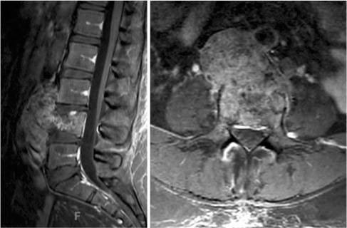 Figure 27.1, A 45-year-old woman presented with intractable lower back pain. Preoperative magnetic resonance imaging (MRI) shows a tumor arising from the L4 vertebra. Left : sagittal T1-weighted postcontrast MRI showing the lesion involving the L3–L5 vertebrae. Right : axial T1-weighted postcontrast MRI showing displacement of the aorta and vena cava. The patient underwent a computed tomography-guided biopsy and the diagnosis was consistent with chordoma.