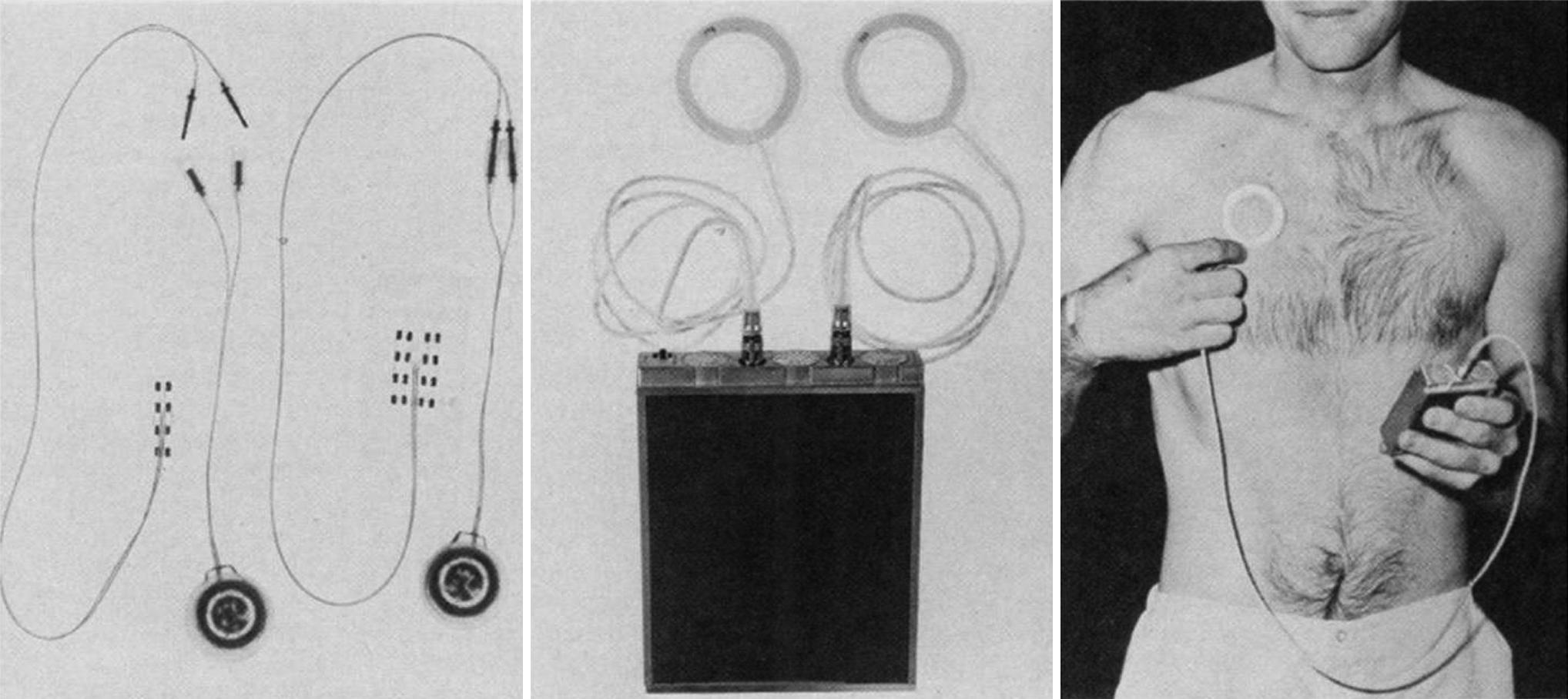 FIGURE 101.1, Irving Cooper’s cerebellar stimulator, consisting of internally implanted electrode plates and receiver (left) , external antenna and transmitter (center) , positioned over the internal receiver during stimulation (right) .