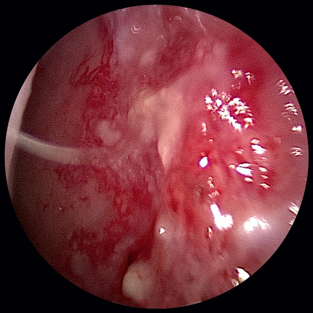 Fig. 100.1, Conglomeration of telangiectasias on the right anterior septum of a hereditary hemorrhagic telangiectasia patient.