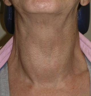 Fig. 8.2, Visible and palpable diffuse goiter, characteristic of Graves’ disease.