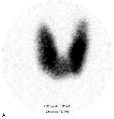 Fig. 8.3, Thyroid Uptake Scintigraphy.