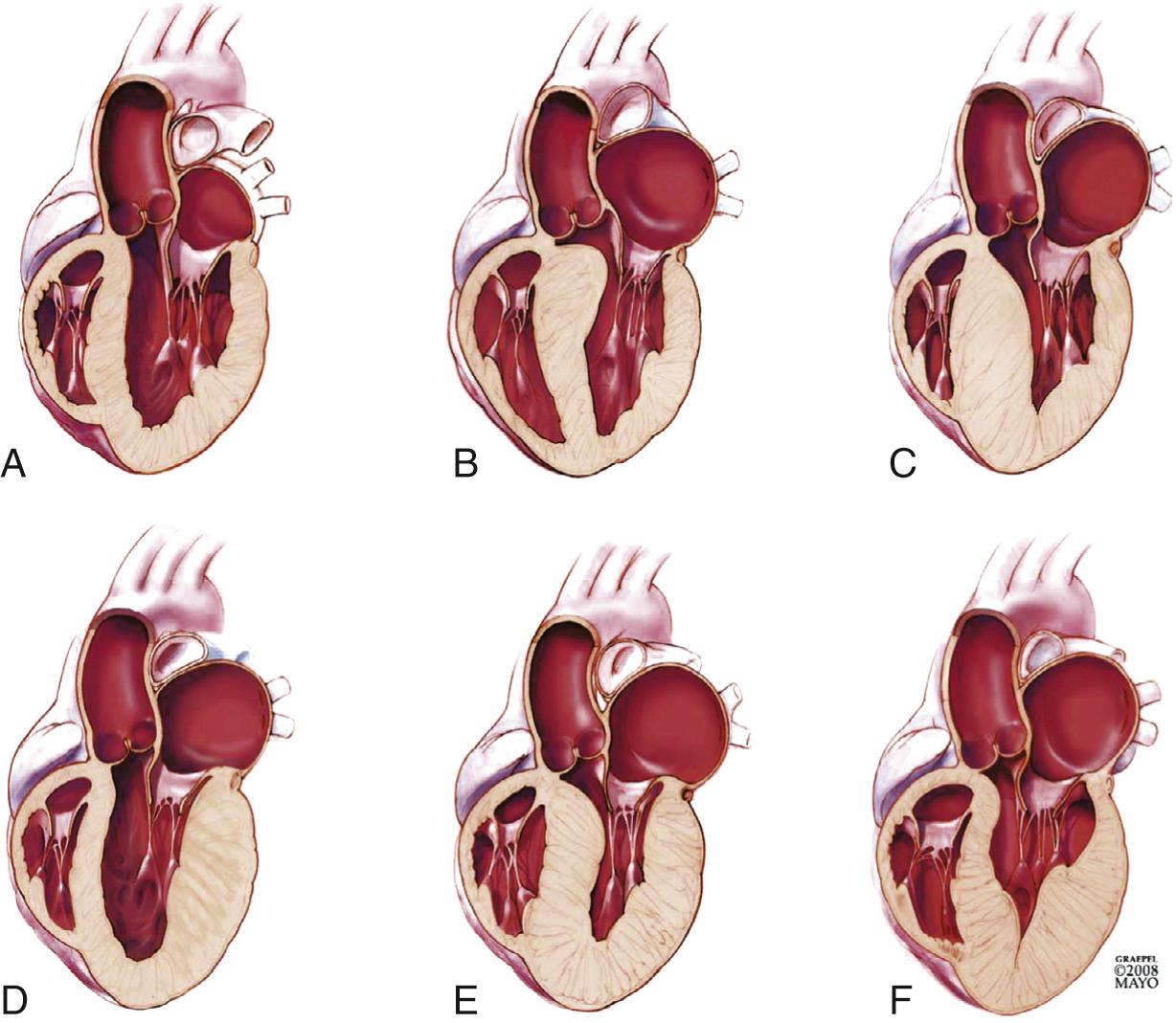 FIGURE 96-1, Morphologic subtypes of hypertrophic cardiomyopathy. Hypertrophy may be localized to the basal septum, as in B; diffuse, as in E; or predominantly apical, as in F. Normal ventricular morphology is shown in A.