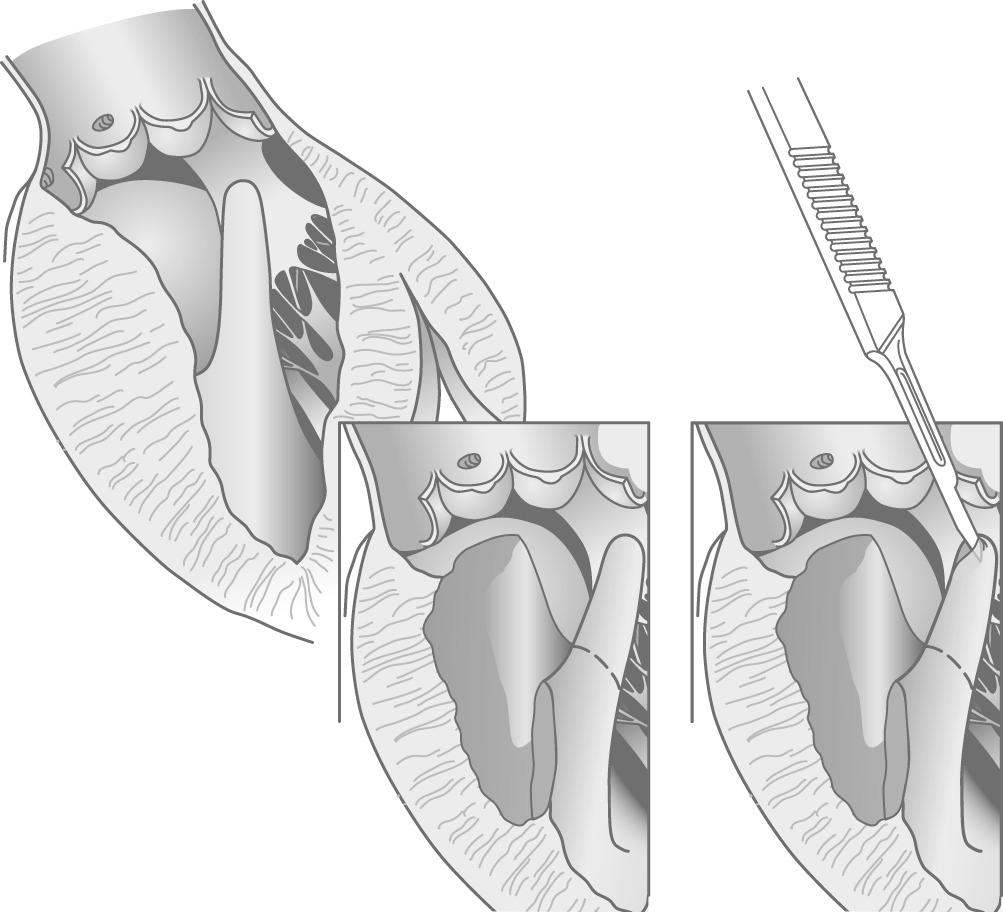 FIGURE 96-2, Anomalous papillary muscles may insert directly into the anterior mitral leaflet and contribute to outflow obstruction. When the anomalous muscle does not support the free edge of the valve, it can be excised.
