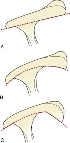 FIG. 12.1, Classification of acromial morphology and its prevalence. Bigliani types II and III acromia are more likely to be associated with impingement syndrome.