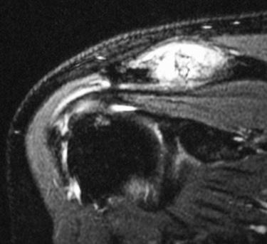 FIG. 12.2, Coronal T2-weighted fat-saturated magnetic resonance imaging study demonstrating acromioclavicular joint space narrowing, irregularity, and profound edema of the medial acromion and lateral clavicle.