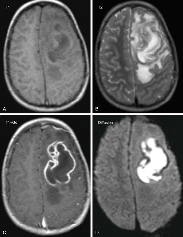 Figure 59.1, Large left-sided frontal-parietal brain abscess axial MRI scans, (A) T1, (B) T2, (C) T1 with gadolinium, and (D) diffusion sequences. The T2 image shows the large surrounding edema causing midline deviation, and the T1 with gadolinium images show the hyperintense rim surrounding the abscess. These images show the imaging similarity between some types of high-grade gliomas and fully developed brain abscesses.