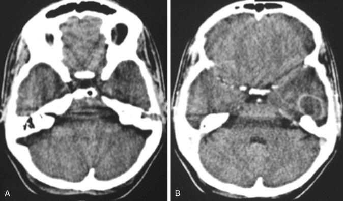 Figure 59.2, Classic temporal localization of a brain abscess caused by a chronic left-sided mastoiditis (left mastoid cell pneumatization). Images taken before (A) and after (B) the administration of contrast media. (B) The ring enhancement after contrast.