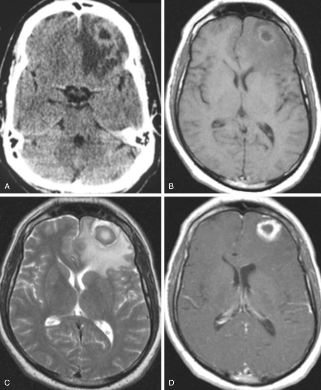 Figure 59.3, Axial images of large left-sided frontal brain LATE abscess. CT scan and MRI images, (A) T1, (B) T2, (C) T1 with gadolinium, and (D) diffusion sequences. The T2 image shows the large surrounding edema causing midline deviation, and the T1 with gadolinium images show the hyperintense rim surrounding the abscess.