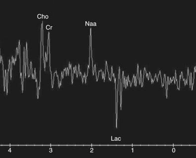 Figure 59.4, Spectroscopy shows characteristic findings in patients with brain pyogenic abscess: elevated choline (Cho), creatine (Cr), N -acetylaspartate (NAA), and decreased lactate (Lac).