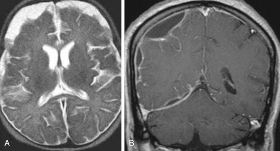 Figure 59.5, (A) T2 weighted axial MRI image; the collection is hyper intense in relation to the brain and iso- or hypo intense in relation to the CSF. (B) A T1-weighted with gadolinium coronal image of a empyema is hypo intense in relation to the brain and hyper intense in relation to the CSF, it also presents ring enhancement.