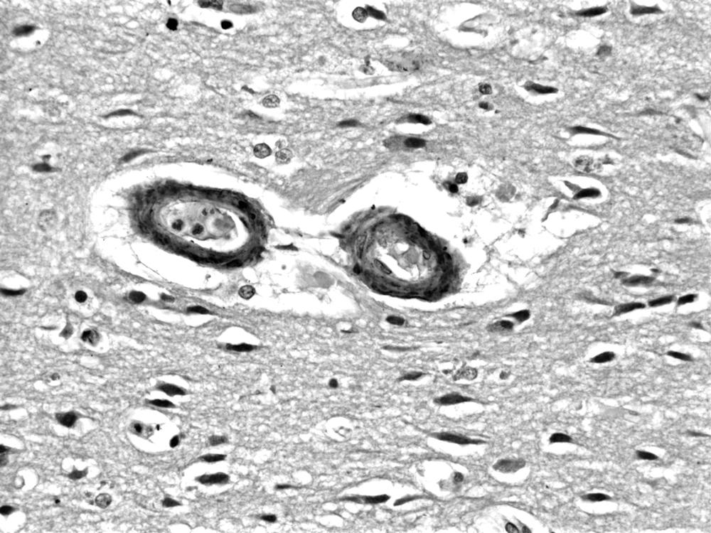 FIGURE 43.1, Amyloid angiopathy histology.