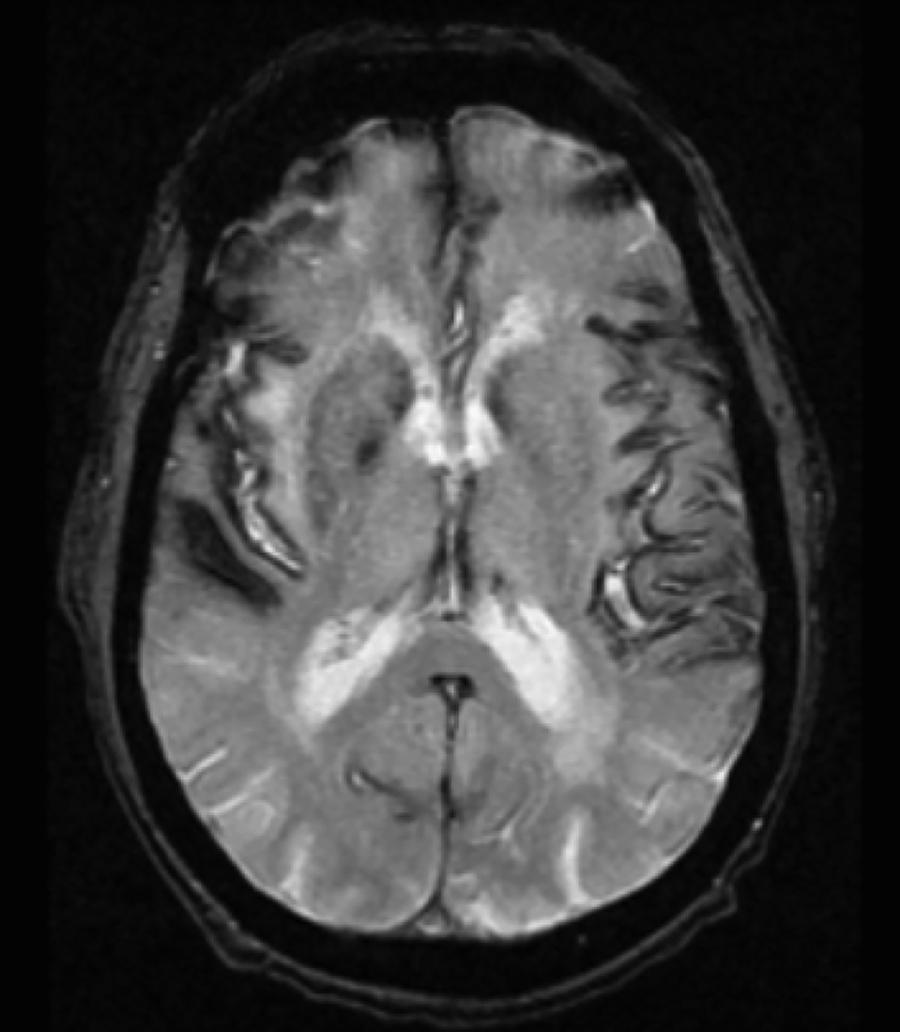 FIGURE 43.2, Siderosis.