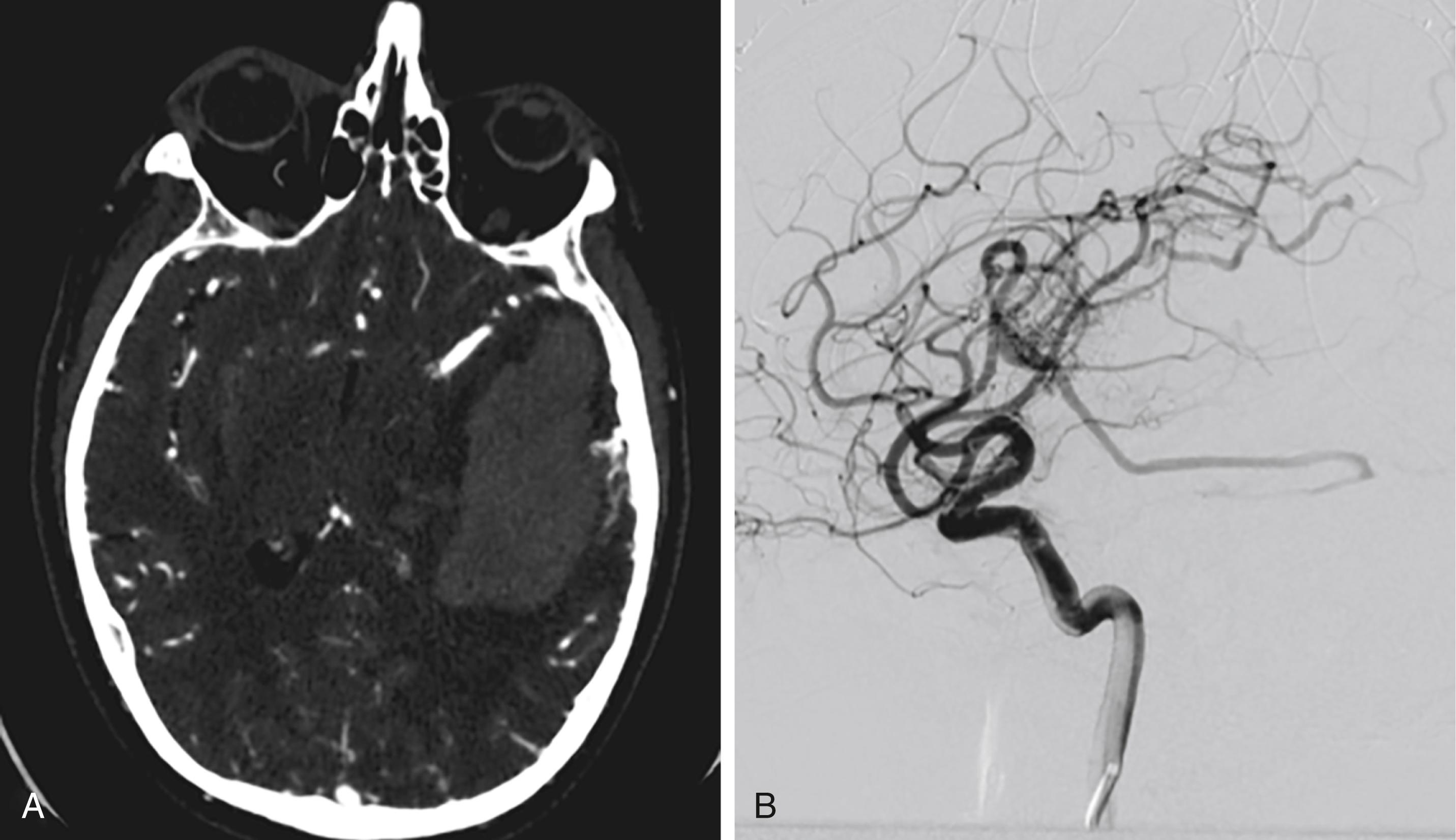 FIGURE 43.3, Arteriovenous malformation-related intracerebral hemorrhage and angiogram. A, CT angiogram demonstrating hemorrhage and superifical tangle of vessels. B, Diagnostic Cerebral Angiogram confirming presence of arteriovenous malformation with associated nidus and early venous drainage.