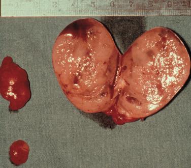 Fig. 60.2, Asymmetric glandular enlargement in a patient with MEN 1-associated HPT (ruler in centimeters).